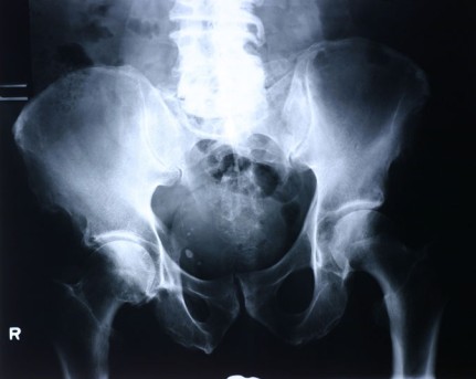 Femoral Osteotomy by OrangeCountySurgeons